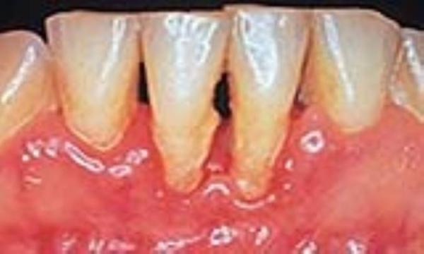 نحوه درمان لثه های عفونی